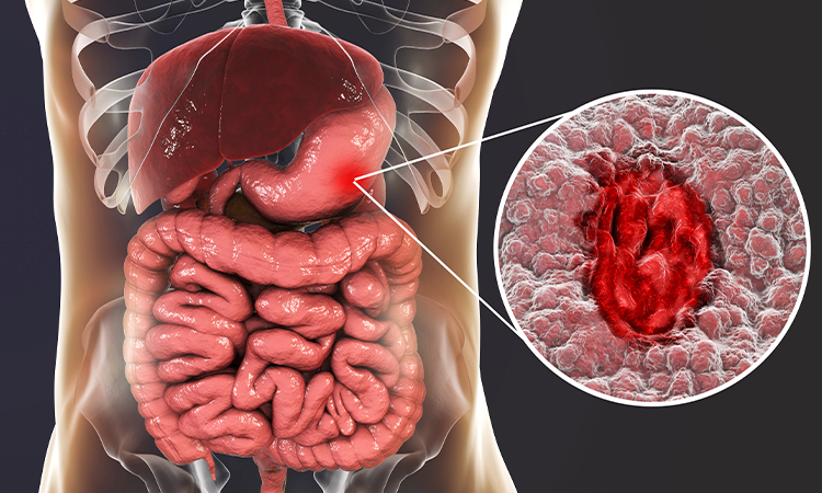 পেটের আলসার কারণ, লক্ষণ ও চিকিৎসা